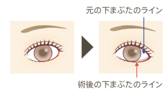タレ目整形のイメージ図